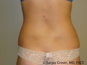 Liposuction Before and After 04 | Sanjay Grover MD FACS
