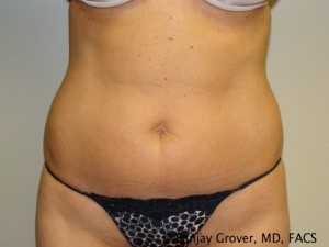 Liposuction Before and After 59 | Sanjay Grover MD FACS