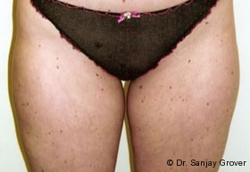 Liposuction Before and After 48 | Sanjay Grover MD FACS