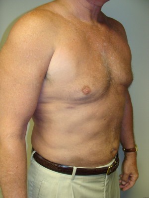 Liposuction Before and After 16 | Sanjay Grover MD FACS