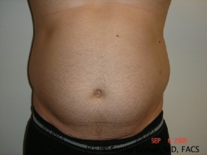 Liposuction Before and After 18 | Sanjay Grover MD FACS