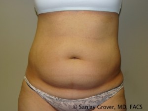Liposuction Before and After 35 | Sanjay Grover MD FACS