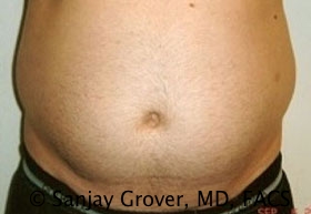 Liposuction Before and After 48 | Sanjay Grover MD FACS