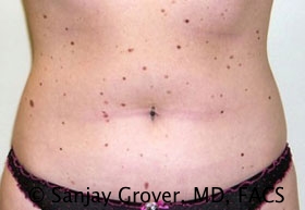Liposuction Before and After 23 | Sanjay Grover MD FACS