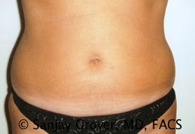 Liposuction Before and After 54 | Sanjay Grover MD FACS