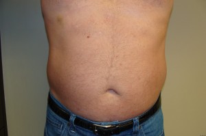 Liposuction Before and After 45 | Sanjay Grover MD FACS