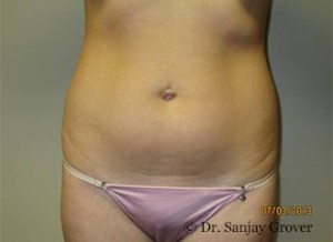 Liposuction Before and After 40 | Sanjay Grover MD FACS