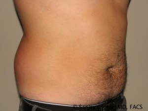 Liposuction Before and After 52 | Sanjay Grover MD FACS