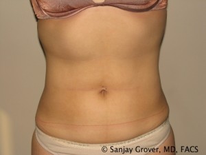 Liposuction Before and After 09 | Sanjay Grover MD FACS