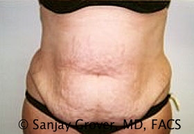 Tummy Tuck Before and After 99 | Sanjay Grover MD FACS