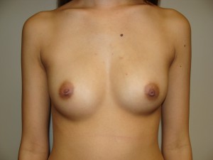 Breast Augmentation Before and After 236 | Sanjay Grover MD FACS