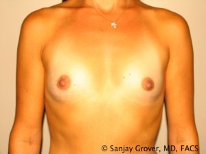 Breast Augmentation Before and After 214 | Sanjay Grover MD FACS