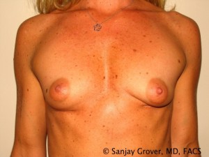 Breast Augmentation Before and After 67 | Sanjay Grover MD FACS