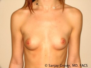 Breast Augmentation Before and After 282 | Sanjay Grover MD FACS