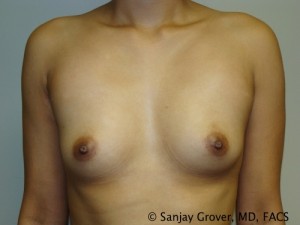 Breast Augmentation Before and After 180 | Sanjay Grover MD FACS