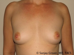 Breast Augmentation Before and After 268 | Sanjay Grover MD FACS