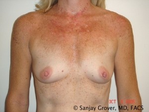 Breast Augmentation Before and After 131 | Sanjay Grover MD FACS