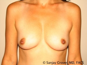 Breast Augmentation Before and After 211 | Sanjay Grover MD FACS
