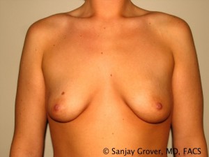 Breast Augmentation Before and After 231 | Sanjay Grover MD FACS