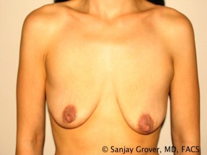 Breast Augmentation Before and After 290 | Sanjay Grover MD FACS