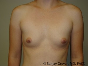 Breast Augmentation Before and After 08 | Sanjay Grover MD FACS
