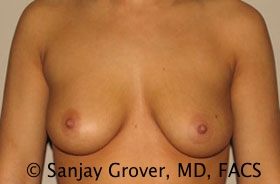 Breast Augmentation Before and After 39 | Sanjay Grover MD FACS