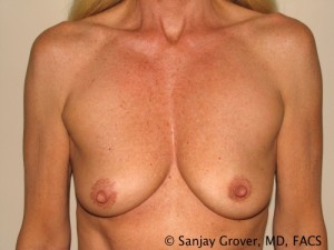 Breast Augmentation Before and After 09 | Sanjay Grover MD FACS