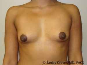Breast Augmentation Before and After 81 | Sanjay Grover MD FACS