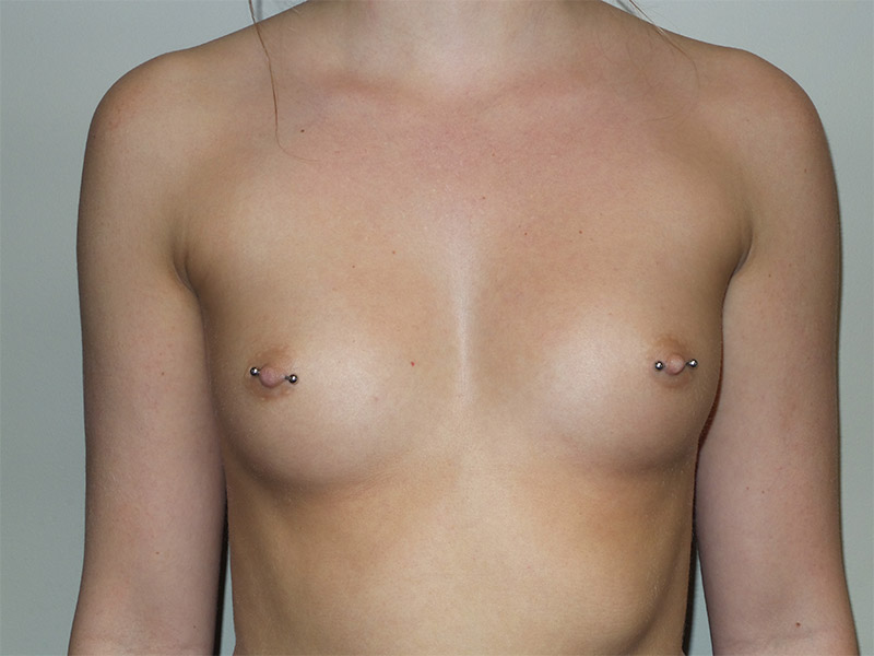 Breast Augmentation Before and After 200 | Sanjay Grover MD FACS