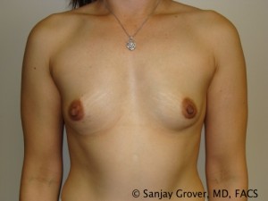 Breast Augmentation Before and After 166 | Sanjay Grover MD FACS
