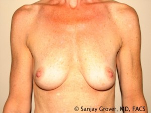 Breast Augmentation Before and After 182 | Sanjay Grover MD FACS