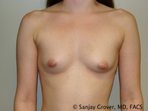 Breast Augmentation Before and After 291 | Sanjay Grover MD FACS