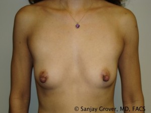 Breast Augmentation Before and After 175 | Sanjay Grover MD FACS
