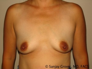 Breast Augmentation Before and After 311 | Sanjay Grover MD FACS