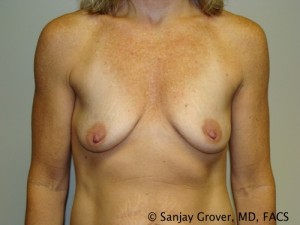 Breast Augmentation Before and After 110 | Sanjay Grover MD FACS