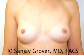 Breast Augmentation Before and After 93 | Sanjay Grover MD FACS