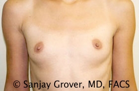 Breast Augmentation Before and After 178 | Sanjay Grover MD FACS