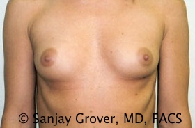 Breast Augmentation Before and After 55 | Sanjay Grover MD FACS