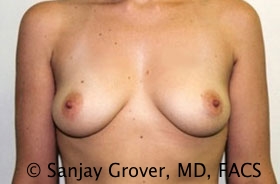 Breast Augmentation Before and After 258 | Sanjay Grover MD FACS