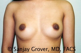 Breast Augmentation Before and After 79 | Sanjay Grover MD FACS