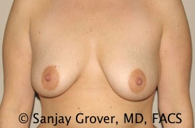 Breast Augmentation Before and After 212 | Sanjay Grover MD FACS