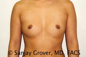 Breast Augmentation Before and After 256 | Sanjay Grover MD FACS