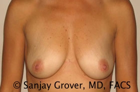 Breast Augmentation Before and After 267 | Sanjay Grover MD FACS
