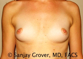 Breast Augmentation Before and After 286 | Sanjay Grover MD FACS