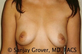 Breast Augmentation Before and After 244 | Sanjay Grover MD FACS