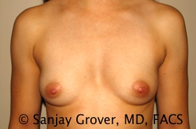Breast Augmentation Before and After 310 | Sanjay Grover MD FACS