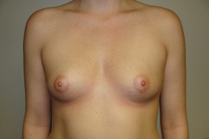 Breast Augmentation Before and After 267 | Sanjay Grover MD FACS