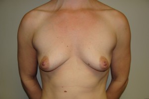 Breast Augmentation Before and After 52 | Sanjay Grover MD FACS