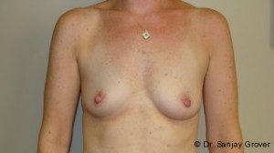 Breast Augmentation Before and After 302 | Sanjay Grover MD FACS