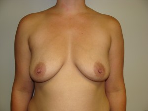 Breast Augmentation Before and After 106 | Sanjay Grover MD FACS